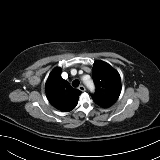 Breast carcinoma with pathological hip fracture (Radiopaedia 60314-67974 A 14).jpg