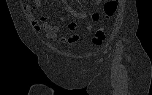 File:Breast carcinoma with pathological hip fracture (Radiopaedia 60314-67993 Coronal bone window 43).jpg