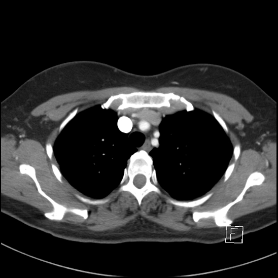 Breast metastases from renal cell cancer (Radiopaedia 79220-92225 A 22).jpg