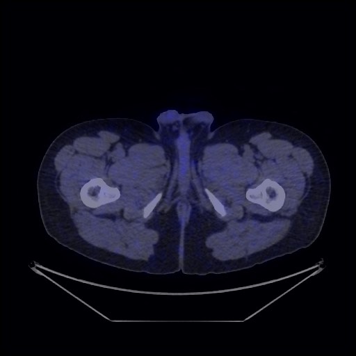 Bronchial carcinoid tumor (Radiopaedia 67377-76765 68Ga-DOTATATE PET-CT 78).jpg