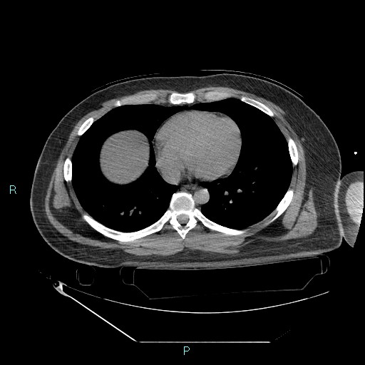 Bronchial carcinoid tumor (Radiopaedia 78272-90870 Axial non-contrast 69).jpg