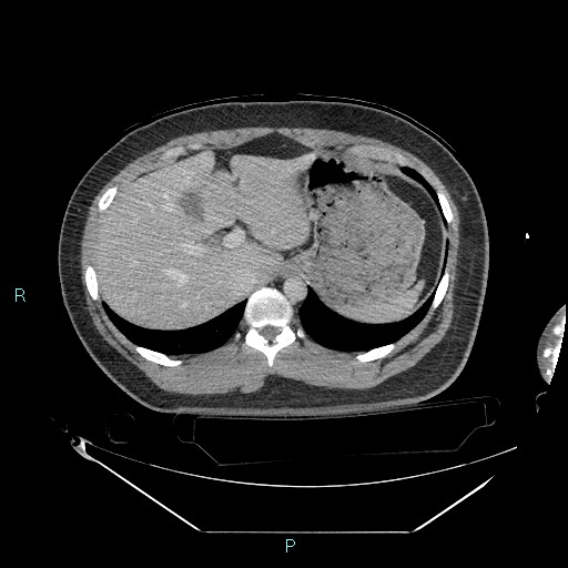 Bronchial carcinoid tumor (Radiopaedia 78272-90870 C 111).jpg
