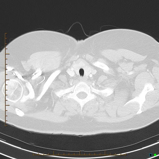 File:Bronchial diverticula (Radiopaedia 79512-92675 Axial lung window 3).jpg