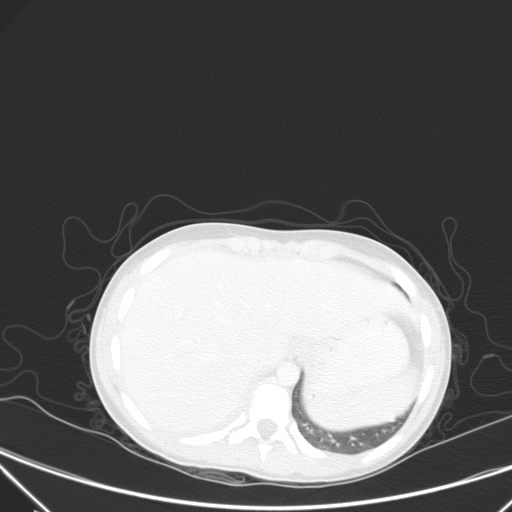 Bronchial mucoepidermoid carcinoma (Radiopaedia 57023-63895 Axial lung window 106).jpg