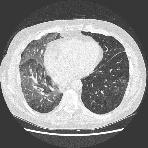 File:Bronchial stenosis - lung transplant (Radiopaedia 73133-83848 C 9).jpg