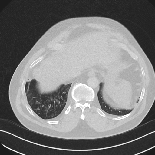 File:Bronchiectasis (Radiopaedia 39385-41666 Axial lung window 54).png
