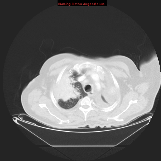 File:Bronchioloalveolar carcinoma (Radiopaedia 9272-9955 Axial lung window 6).jpg