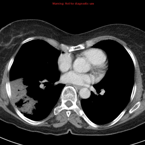 File:Bronchoalveolar carcinoma (BAC) (Radiopaedia 13436-13392 B 31).jpg
