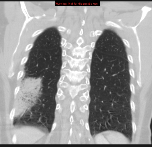 Bronchoalveolar carcinoma (BAC) (Radiopaedia 13436-13392 Coronal lung window 49).jpg
