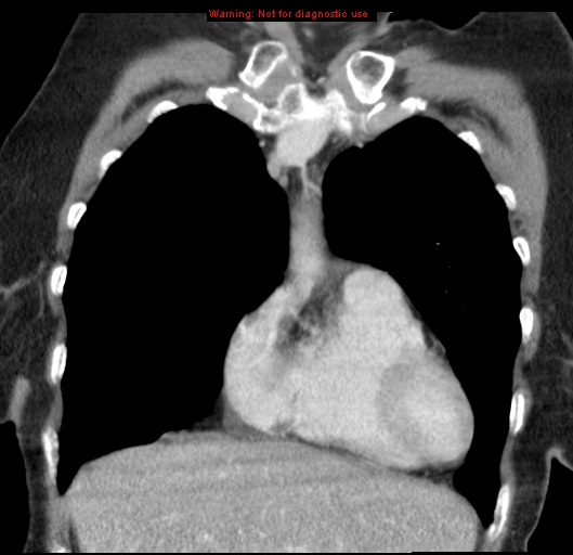 Bronchoalveolar carcinoma (BAC) (Radiopaedia 13436-13392 E 15).jpg