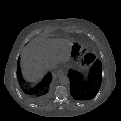 Bronchogenic carcinoma with metastatic lymphadenopathy (Radiopaedia 37671-39569 Axial bone window 45).jpg