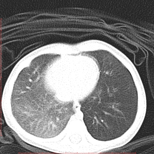 Bronchogenic cyst (Radiopaedia 78599-91409 Axial lung window 109).jpg