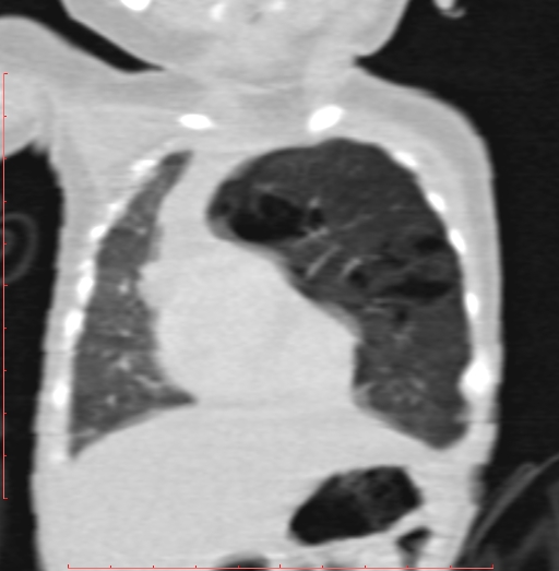 Bronchogenic cyst (Radiopaedia 78599-91409 Coronal lung window 67).jpg