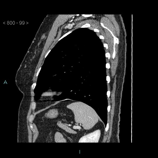 Bronchogenic cyst - posterior mediastinal (Radiopaedia 43885-47364 B 66).jpg