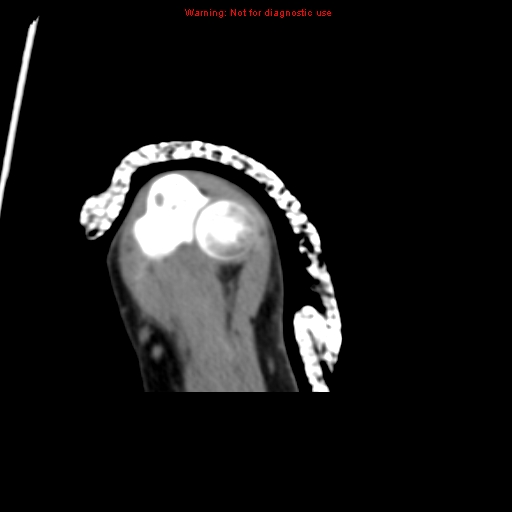 Brown tumor (Radiopaedia 12460-12694 Axial non-contrast 130).jpg