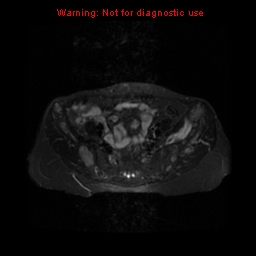 File:Brown tumors (Radiopaedia 9666-10290 Axial T2 fat sat 9).jpg