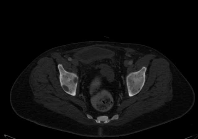 Brown tumors compressing the spinal cord (Radiopaedia 68442-77988 G 112).jpg