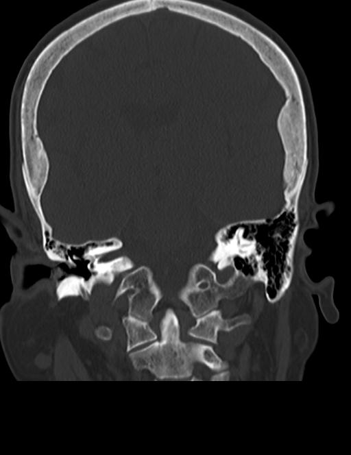 Burnt-out meningioma (Radiopaedia 51557-57337 Coronal bone window 30).jpg