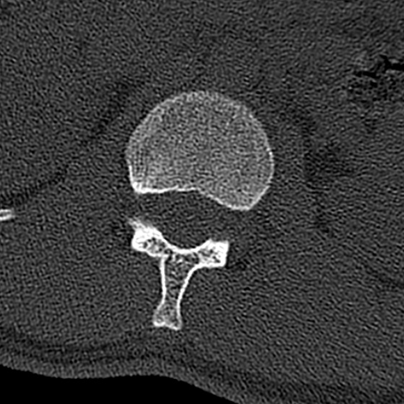 Burst fracture (Radiopaedia 53373-59357 Axial bone window 14).jpg