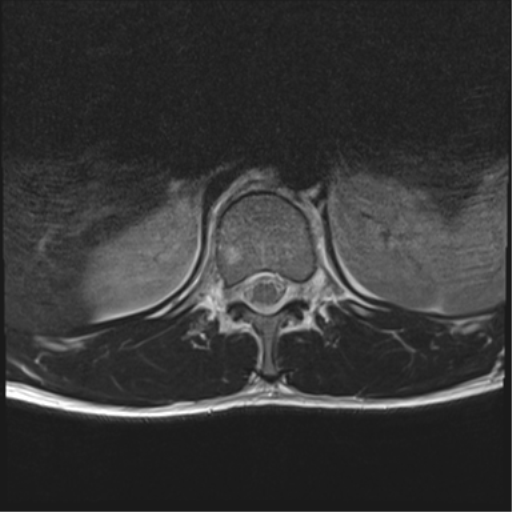 File:Burst fracture - T12 with conus compression (Radiopaedia 56825-63646 Axial T2 19).png