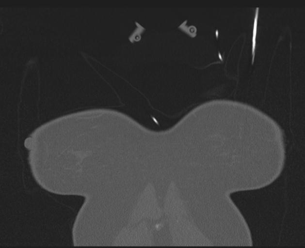 Burst fracture - thoracic spine (Radiopaedia 30238-30865 Coronal bone window 8).jpg