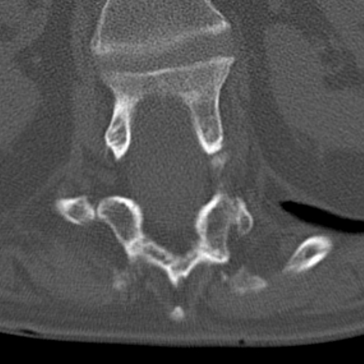 Butterfly vertebrae with kyphoscoliosis (Radiopaedia 14257-14133 Axial bone window 64).jpg