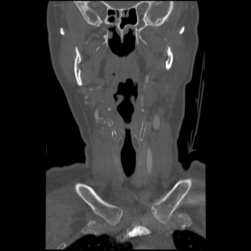 C1 anterior arch (plough) fracture - type 1 (Radiopaedia 76181-87720 Coronal bone window 77).jpg
