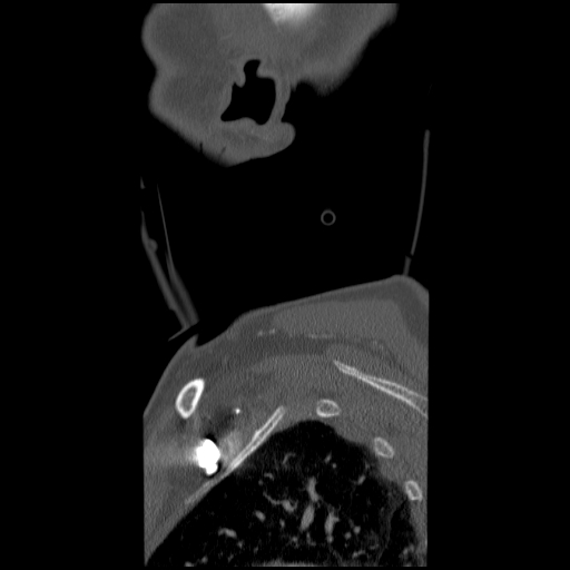 File:C1 anterior arch (plough) fracture - type 1 (Radiopaedia 76181-87720 Sagittal bone window 3).jpg