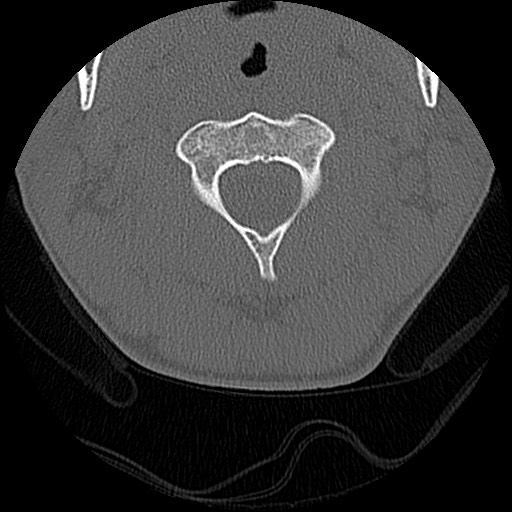 File:C5 facet fracture (Radiopaedia 58374-65499 Axial bone window 23).jpg