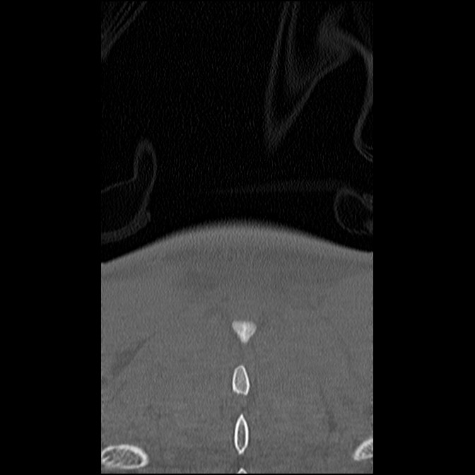 C5 facet fracture (Radiopaedia 58374-65499 Coronal bone window 62).jpg