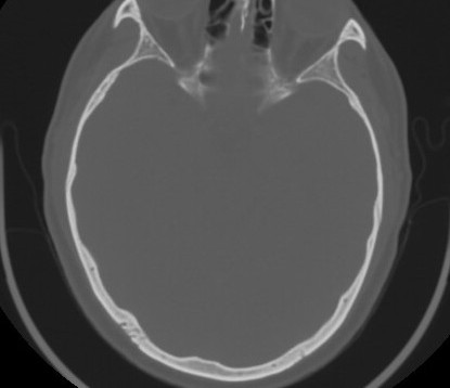 C7 laminar fracture and Klippel-Feil syndrome (Radiopaedia 86710-102850 Axial bone window 1).jpg