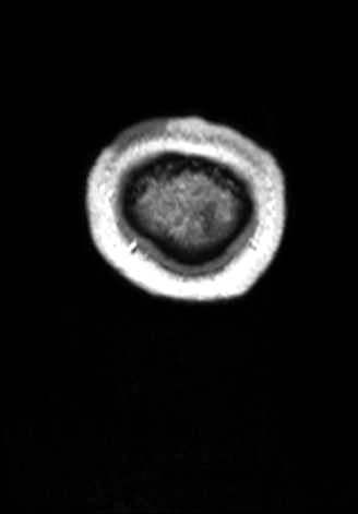 CNS cryptococcosis (Radiopaedia 70895-81108 Coronal T1 C+ 192).jpg