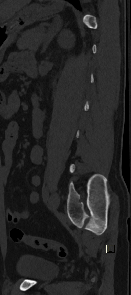 Calcaneal fractures with associated L2 burst fracture (Radiopaedia 71671-82493 Sagittal bone window 11).jpg
