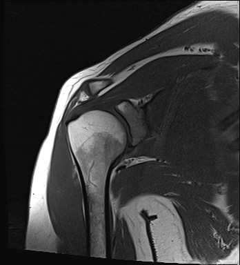 File:Calcific tendinitis of the infraspinatus tendon (Radiopaedia 87256-103537 Coronal T1 11).jpg