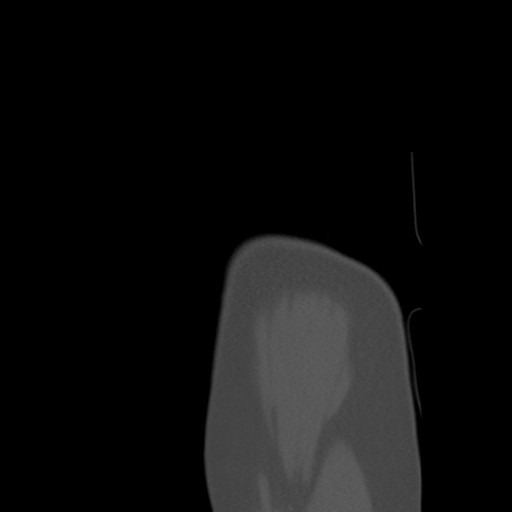 File:Calcific tendinitis of the infraspinatus tendon (Radiopaedia 87256-103539 Sagittal bone window 8).jpg