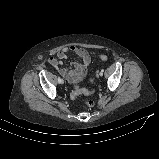 Calcified adrenal glands and Spigelian hernia (Radiopaedia 49741-54988 A 201).jpg