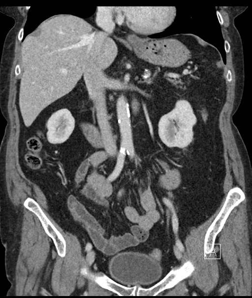 Calcified adrenal glands and Spigelian hernia (Radiopaedia 49741-54988 B 53).jpg
