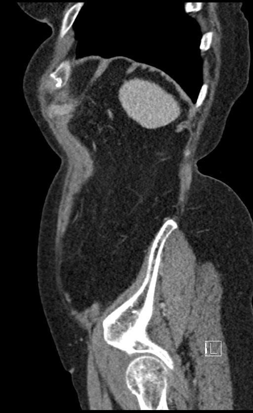 Calcified adrenal glands and Spigelian hernia (Radiopaedia 49741-54988 C 24).jpg