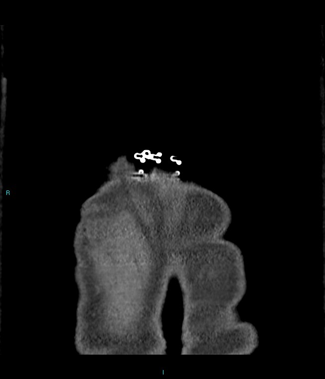 Calcified cerebral emboli from left ventricular thrombus (Radiopaedia 84420-99760 Coronal C+ CTPA 1).jpg