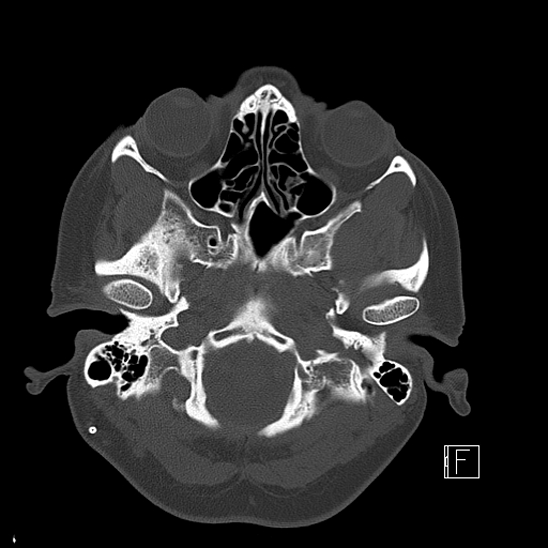 Calcified chronic subdural hematoma (Radiopaedia 77374-89492 Axial bone window 15).jpg
