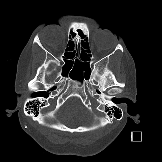 Calcified chronic subdural hematoma (Radiopaedia 77374-89492 Axial bone window 20).jpg