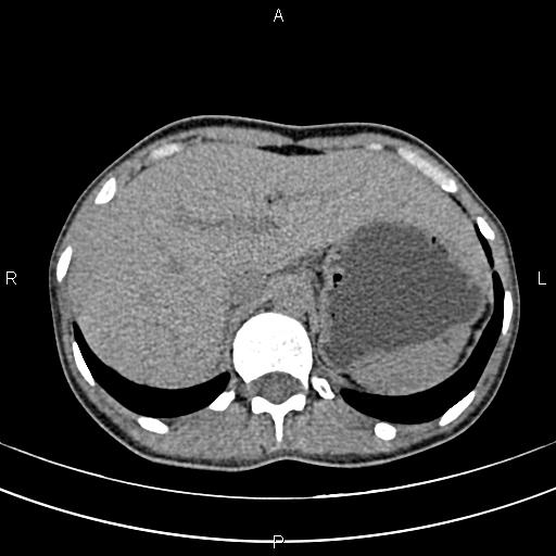 File:Calcified hepatic hydatid cyst (Radiopaedia 83870-99072 Axial non-contrast 37).jpg
