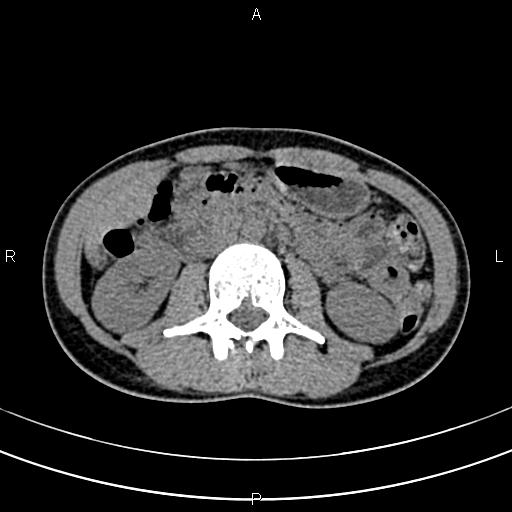 File:Calcified hepatic hydatid cyst (Radiopaedia 83870-99072 Axial non-contrast 85).jpg