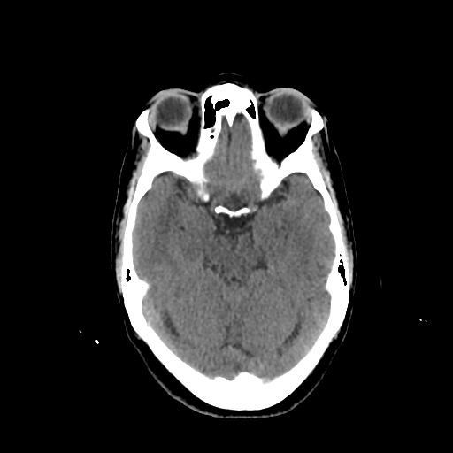 File:Calcified meningioma - cervical canal (Radiopaedia 70136-80171 Axial non-contrast 10).jpg