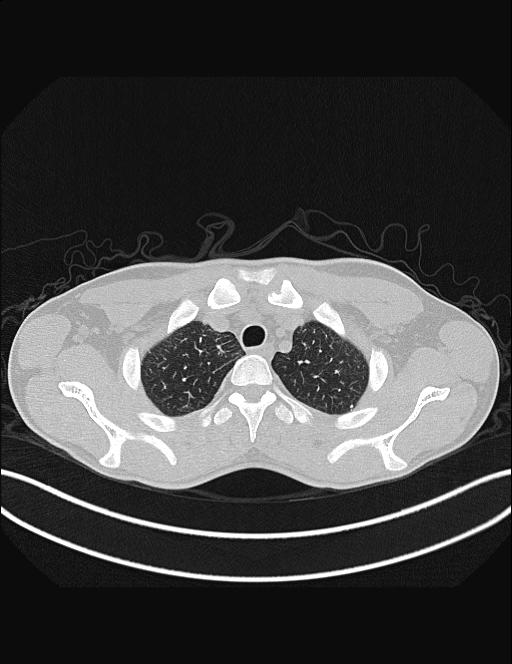 Calcifying pulmonary metastases (Radiopaedia 33359-34396 Axial lung window 10).jpg