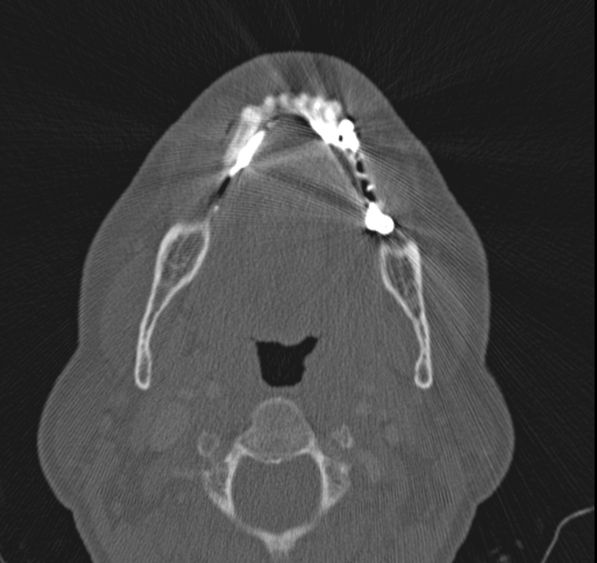 Caldwell-Luc operation (Radiopaedia 52329-58225 Axial bone window 58).jpg