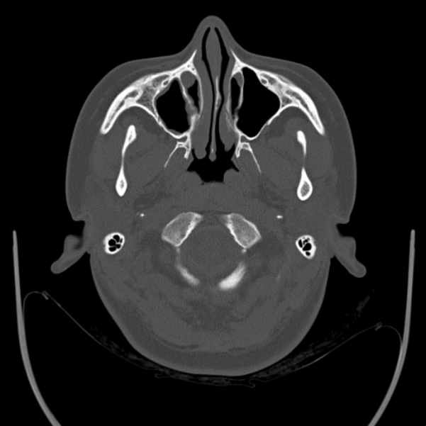 Calvarial osteoma (Radiopaedia 36520-38079 Axial bone window 11).jpg