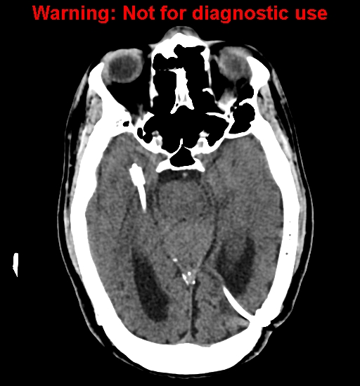 File:Calvarial thickening from chronic shunting (Radiopaedia 60079-67637 Axial non-contrast 13).jpg