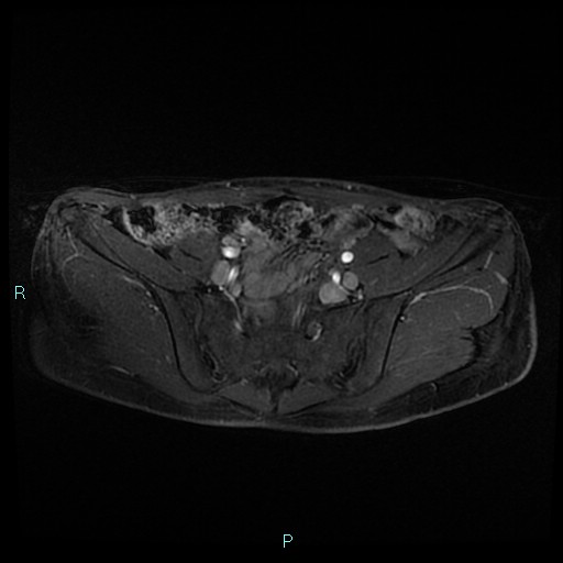 File:Canal of Nuck cyst (Radiopaedia 55074-61448 Axial T1 C+ fat sat 11).jpg