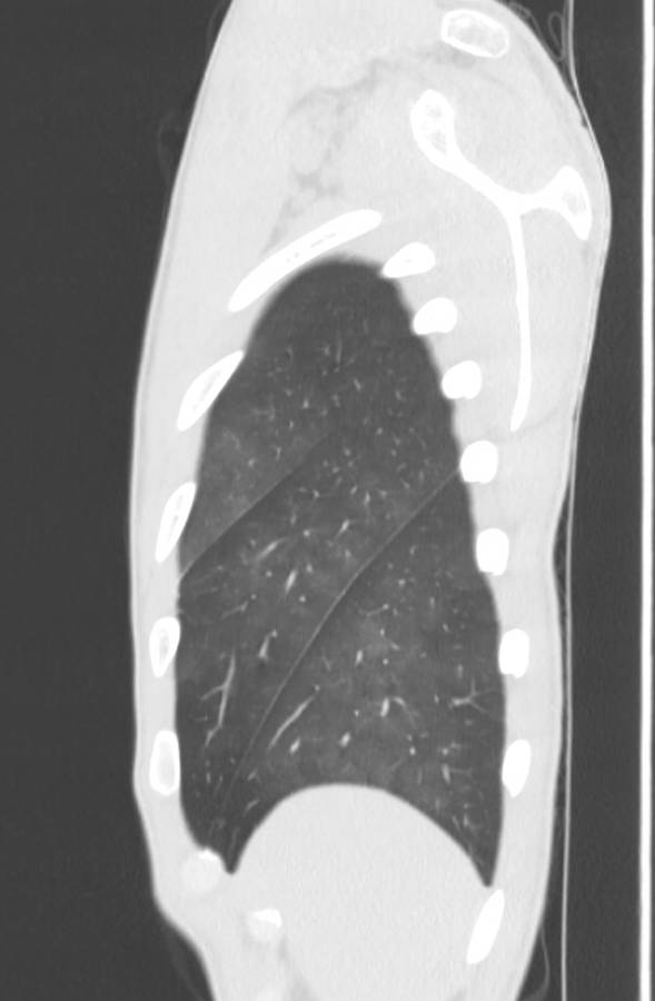 Cannabis-induced diffuse alveolar hemorrhage (Radiopaedia 89834-106946 Sagittal lung window 127).jpg